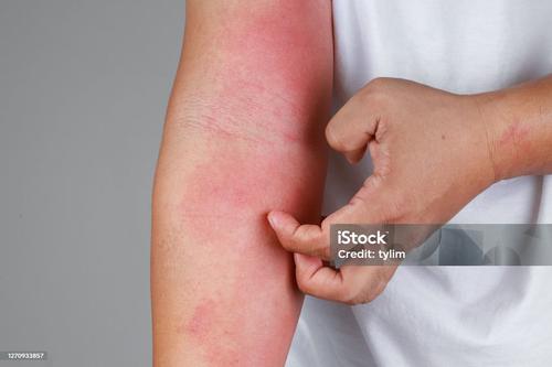 Alergias en la piel